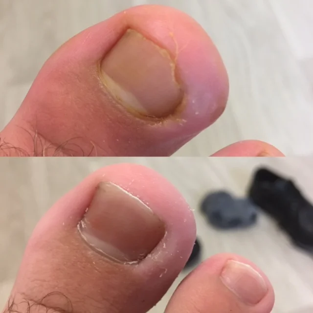 Nail Surgery