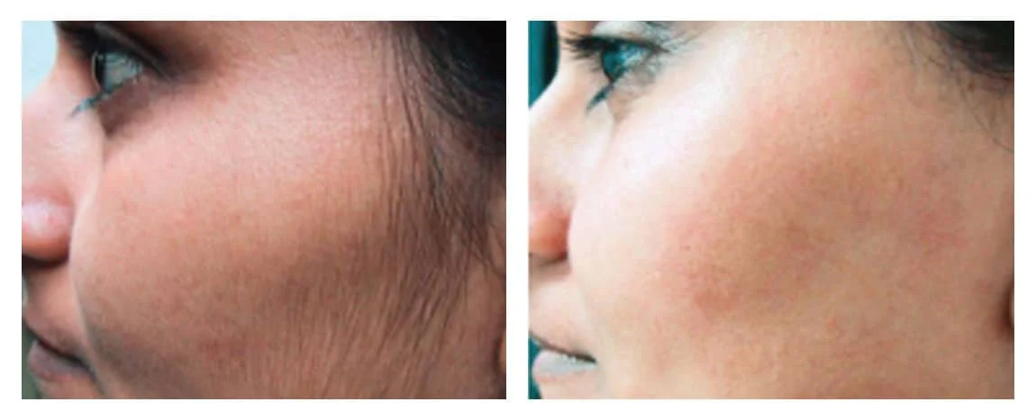 Laser-Hair-Reduction