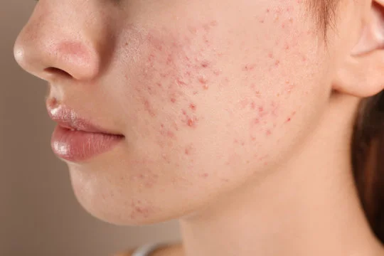 Pimple-Treatment