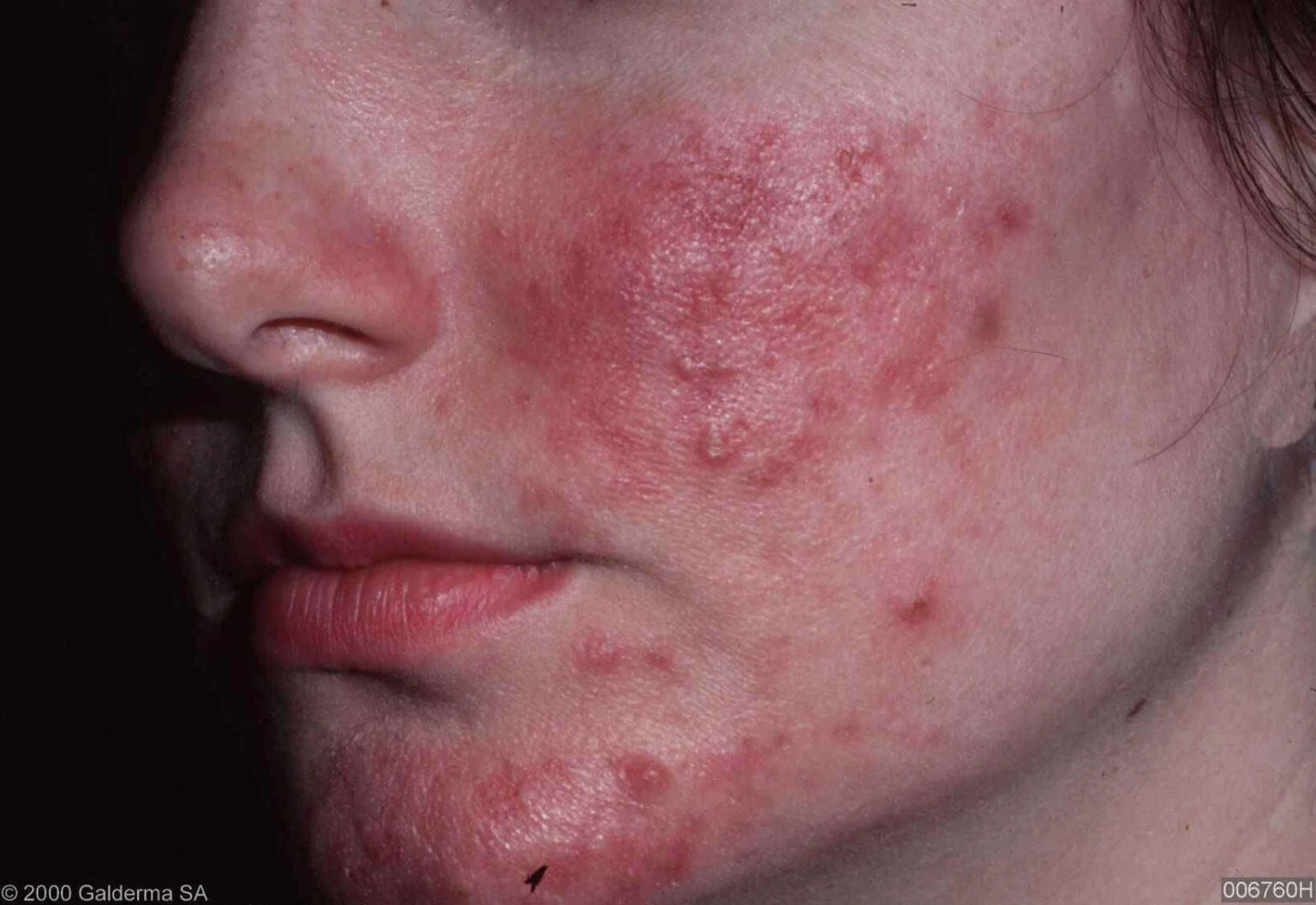 Rosacea