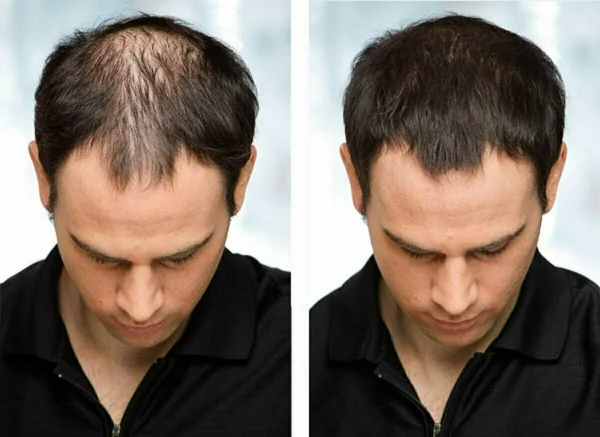 Hair-Fall-Treatment