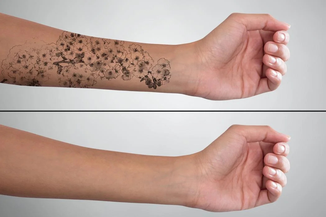 Tattoo-Removal