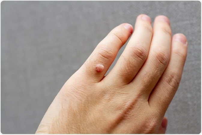 Wart-Removal