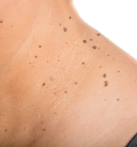 Skin-Tag-Removal