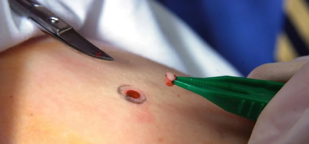 Skin_biopsy Skin-Biopsy