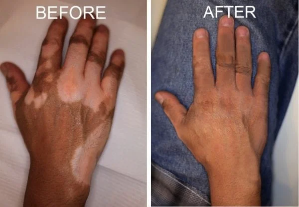 Vitiligo